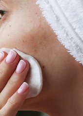 oplossingen-hormonale-acne