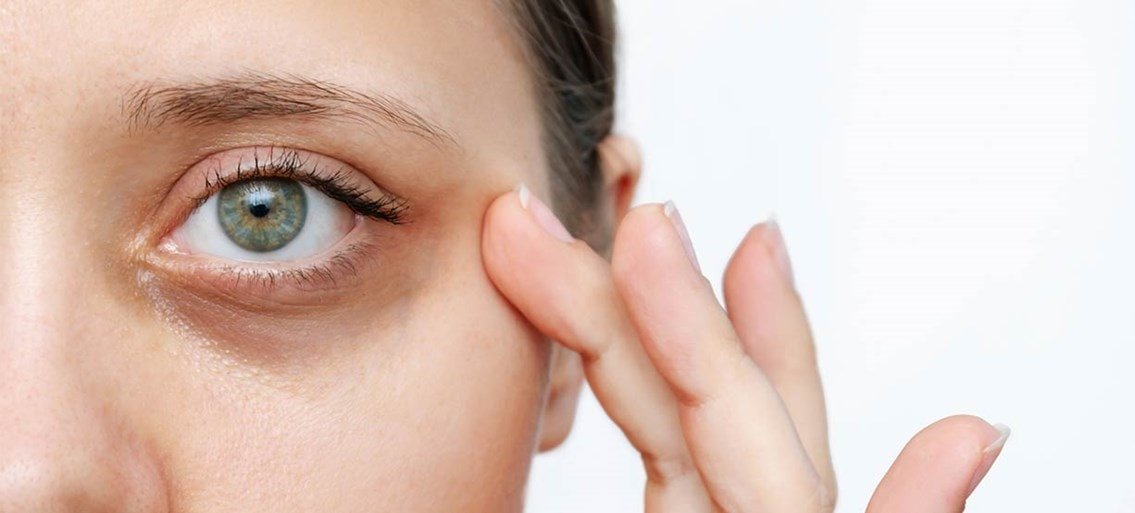 Oorzaken van donkere kringen