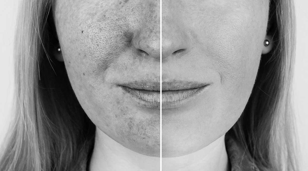 Hoe zonnebrandcrème helpt tegen verschillende soorten pigmentvlekken