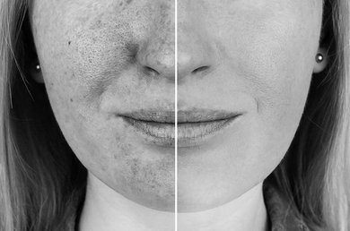 Hoe zonnebrandcrème helpt tegen verschillende soorten pigmentvlekken